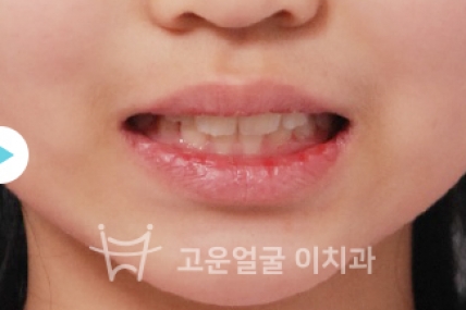 치료후기 이미지